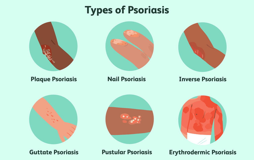 Psoriasis Overview 1069493_v2 7ec3824b67f94a2c8331949a919b70c5 Copy